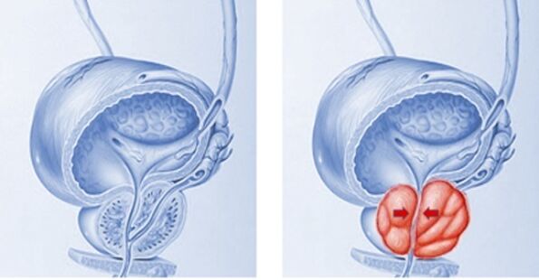 healthy prostate and inflamed with prostatitis